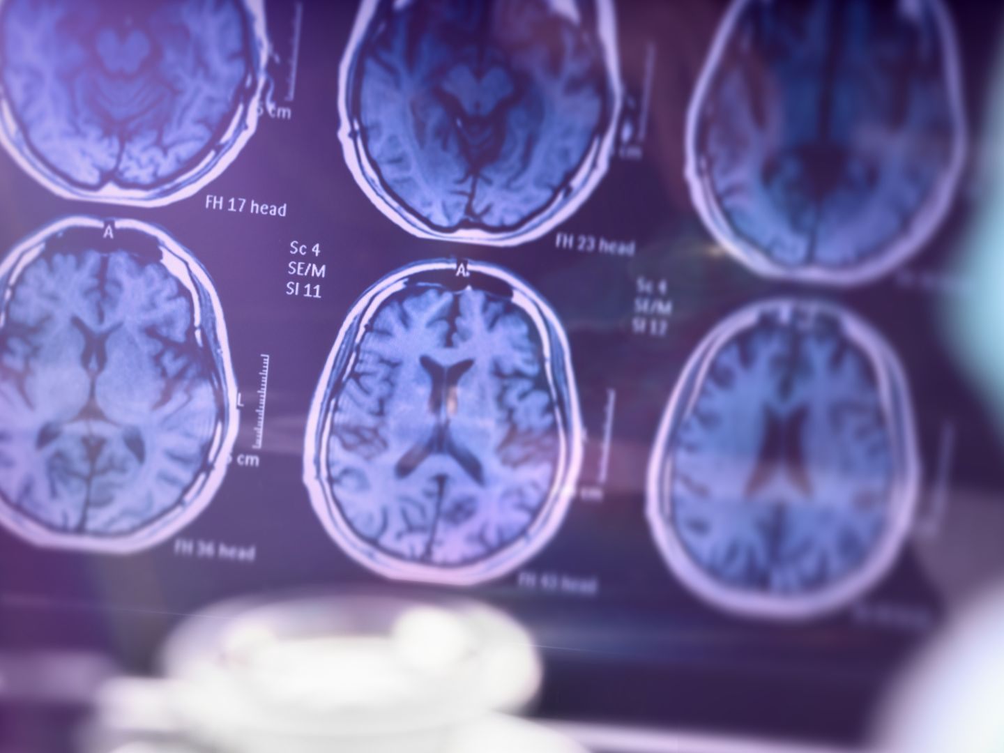 Krebs und Schlaganfall weiterhin gefürchteter als Alzheimer (Symbolbild) Krebs und Schlaganfall weiterhin gefürchteter als Alzheimer (Symbolbild)